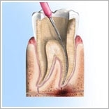 Ondt gør rodbehandlet tand Tandrodsbetændelse